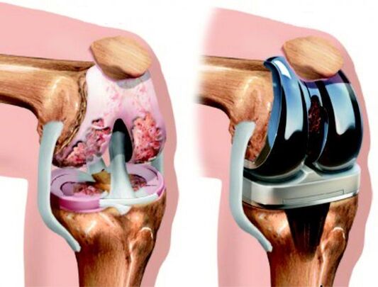 Outcome of knee replacement surgery for osteoarthritis