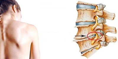 Mechanism of the development of cervical osteochondrosis