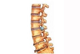 Stages of development of cervical osteochondrosis