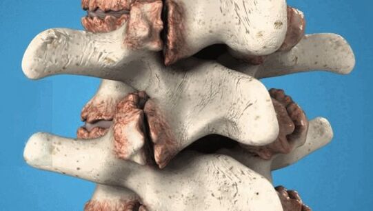 Osteophytes of vertebrae - pathological growths that damage nerves and blood vessels