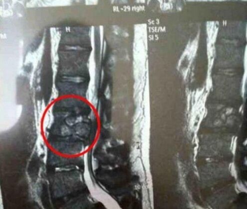 Spine tumor in the picture