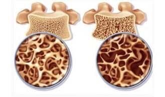 The risk of cervical absorption for women