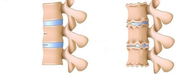 Spine and healthy osteochondrosis