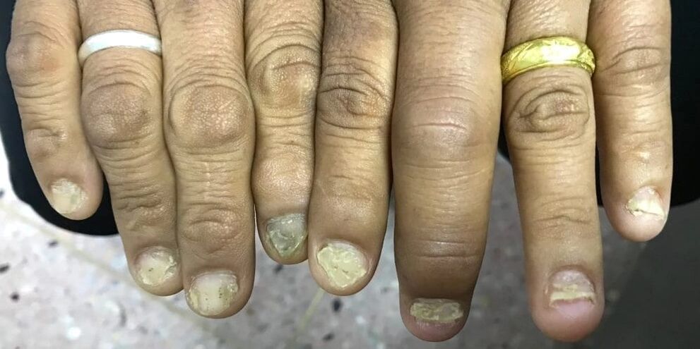 Swelling of the fingers and deformation of the nail plate can indicate the development of psoriatic arthritis