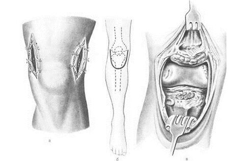 Arthrotomy surgery for osteoarthritis