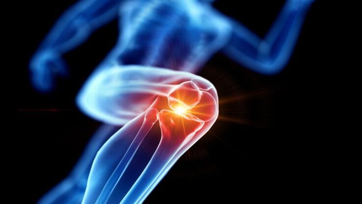 knee osteoarthritis